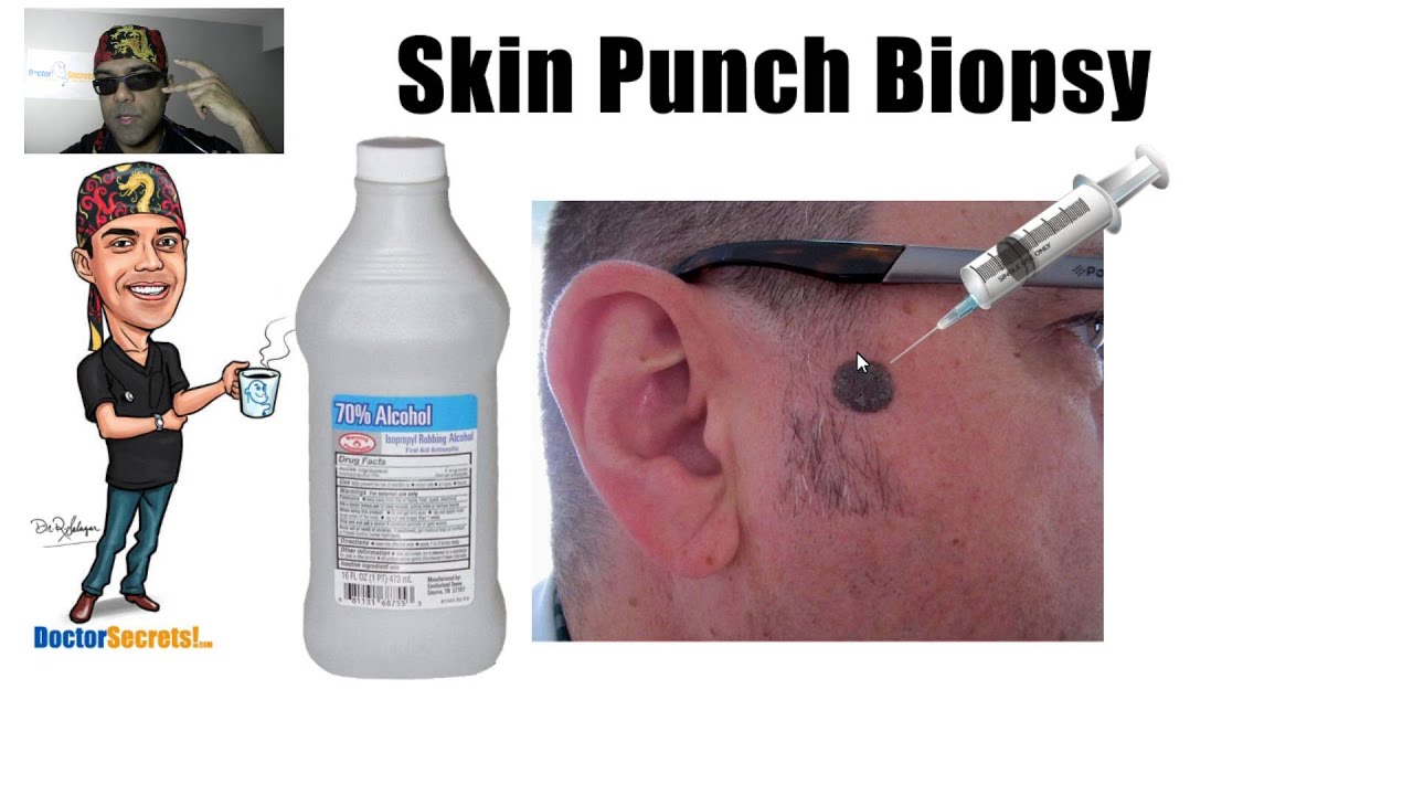 Skin Punch Biopsy Procedure Secrets