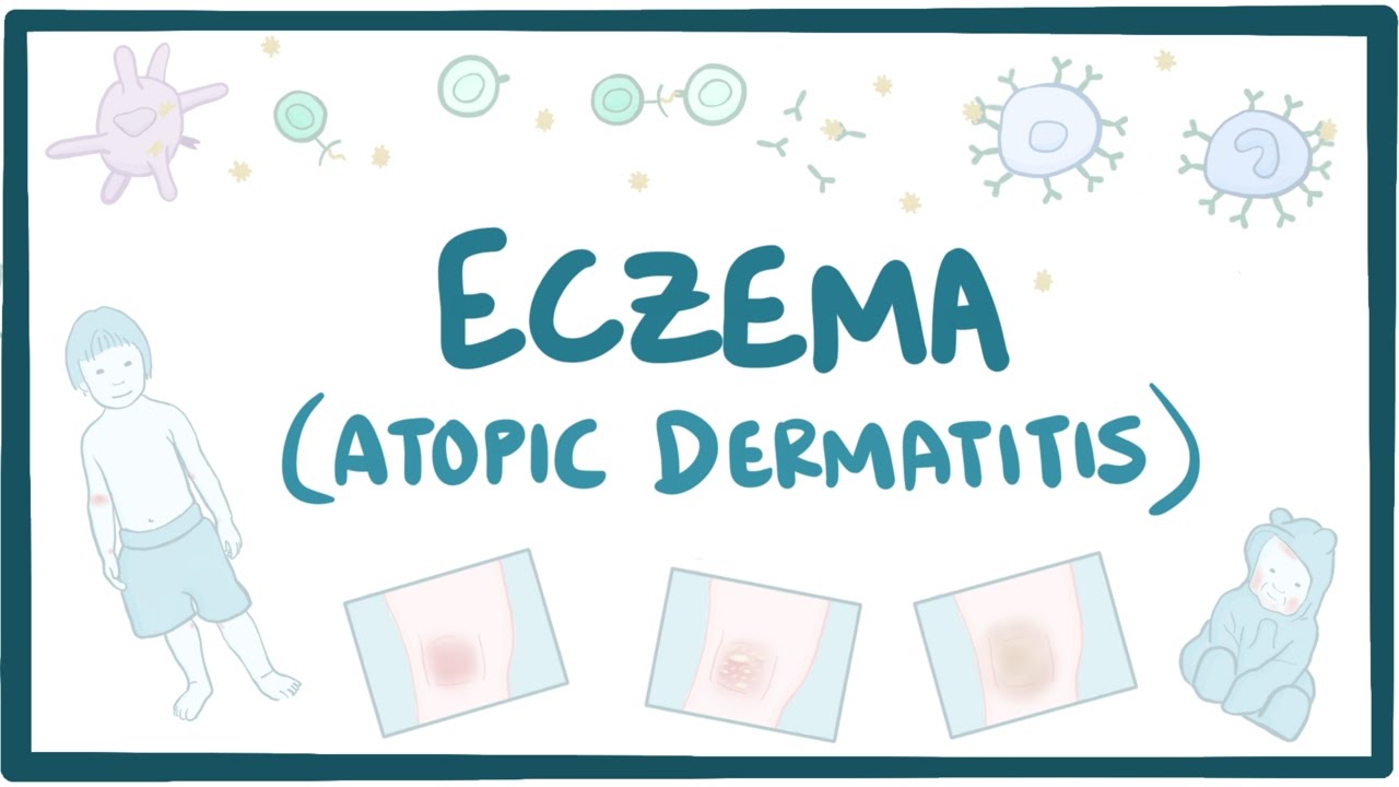 Eczema (atopic dermatitis) - causes, symptoms, diagnosis, treatment, pathology