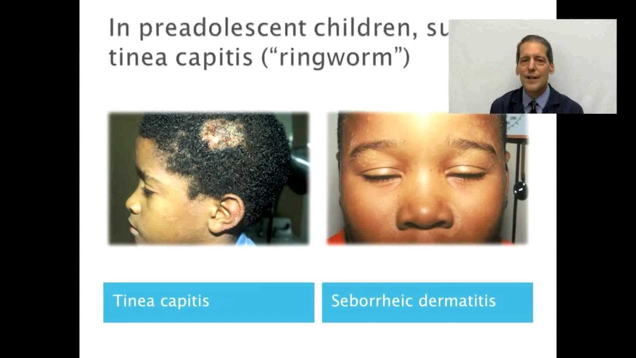 Seborrheic Dermatitis (Dandruff): Diagnosis and Management - OnlineDermClinic