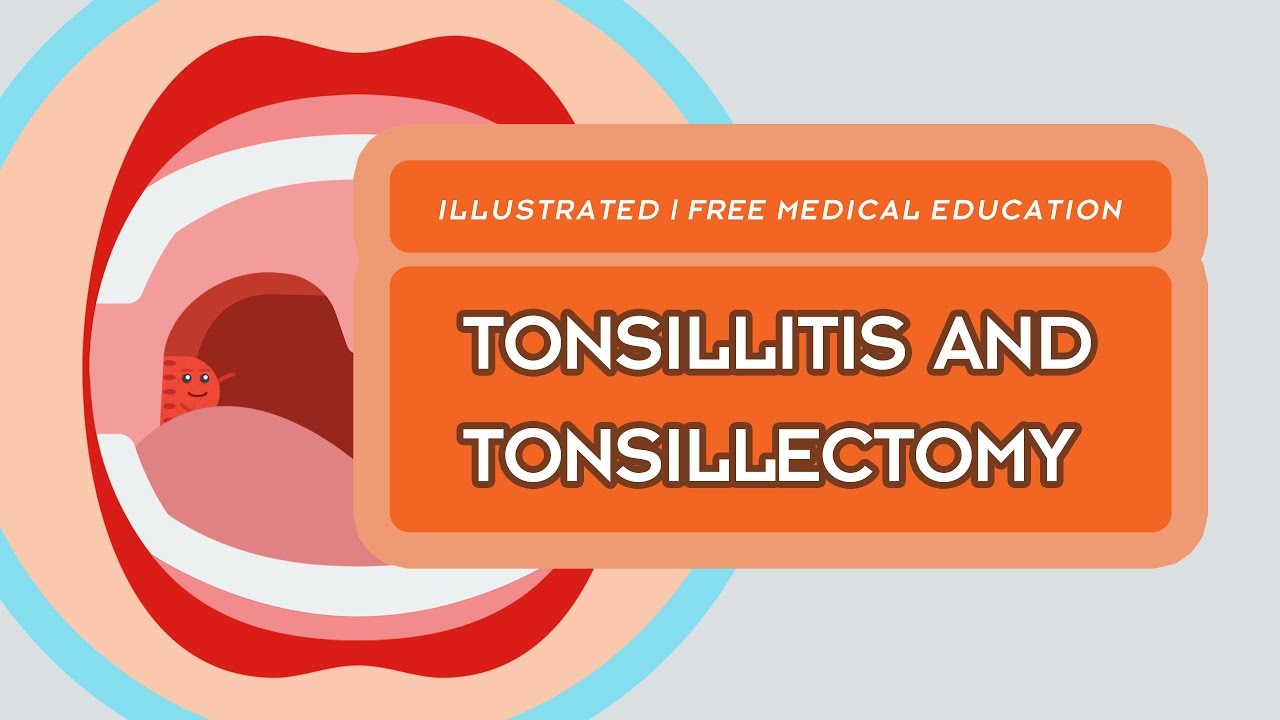 What is Tonsillitis & Tonsillectomy?