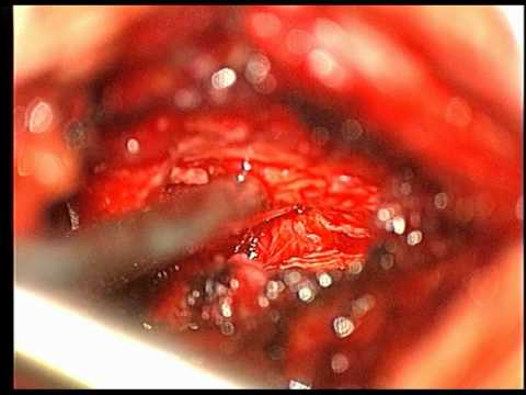 Lumbar herniated disc (L4-L5). Integral procedure
