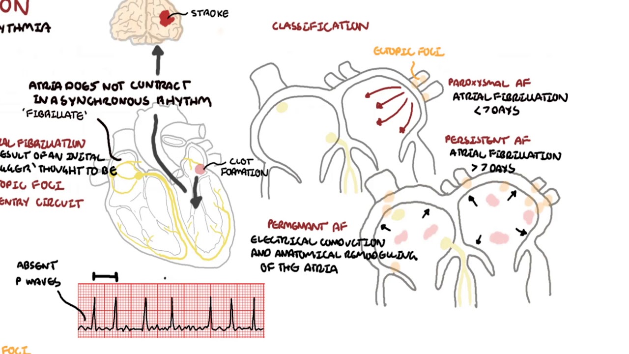 Atrial Fibrillation Overview - ECG, types, pathophysiology, treatment, complications