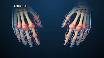Rheumatoid Arthritis Animation