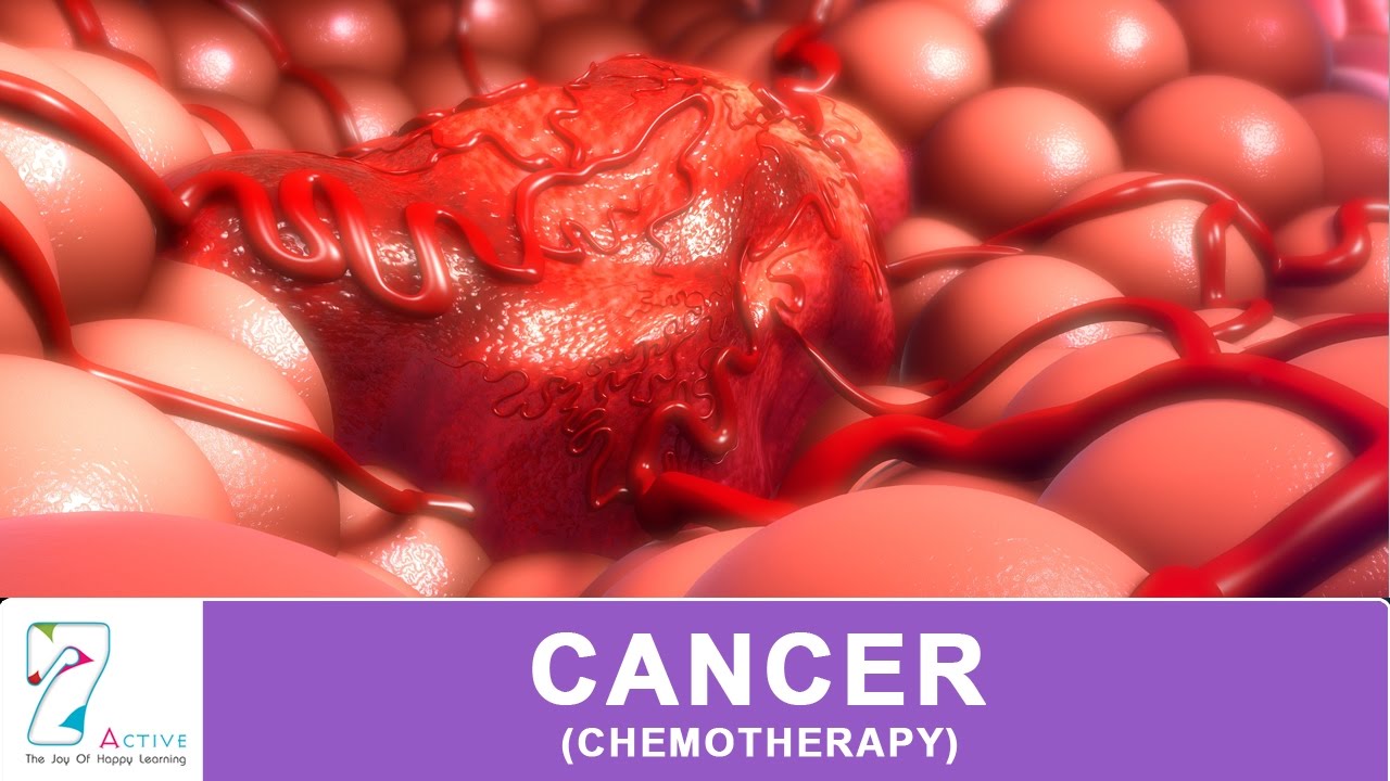 CANCER (CHEMOTHERAPY)