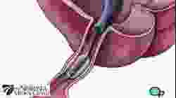 Stent Implantation Coronary Angioplasty Nebraska Patient Education